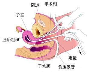 成都棕南医院专业人流